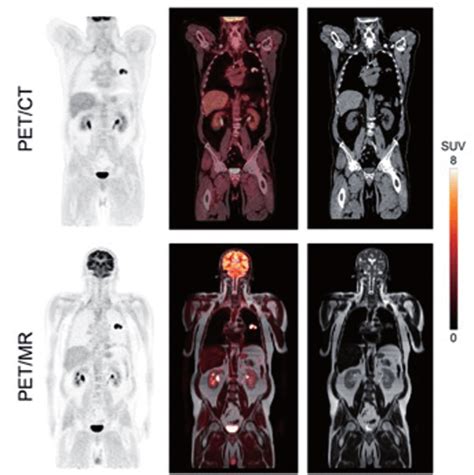 —petct Vs Petmr Images From A Same Patient 4 Pet Ct Imaging At