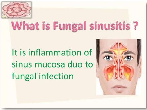 Fungal Sinusitis