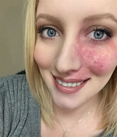 Maybe you would like to learn more about one of these? Girl with birthmark shows her face after finding love ...