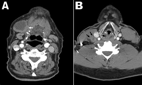 Accuracy Of Computed Tomography For Predicting Pathologic Nodal