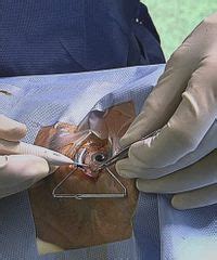 Sie gehören zu den gefährlichsten folgen einer mangelnden durchblutung, denn blutgerinnsel können im schlimmsten fall tödlich enden. Ophthalmika: Cortison-Implantat für den Glaskörper | PZ ...