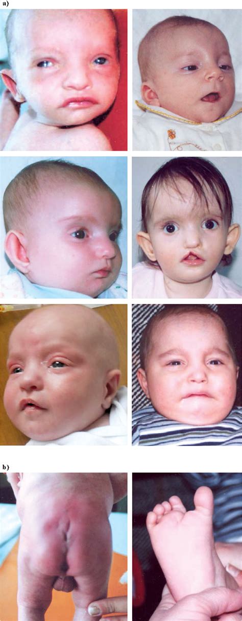 Figure 1 From Phenotypic Variations In Wolf Hirschhorn Syndrome Semantic Scholar