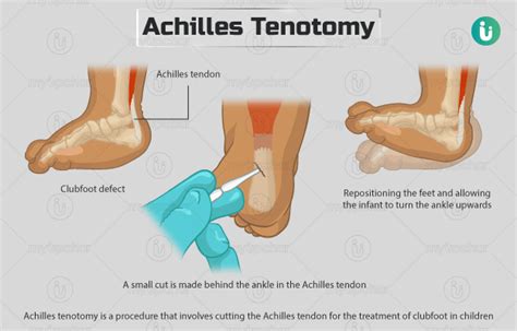 Achilles Tenotomy Procedure Purpose Results Cost Price