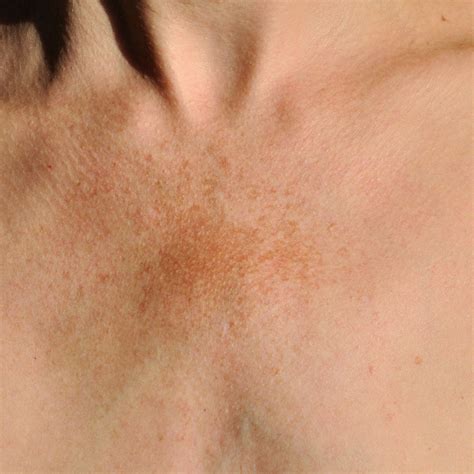 How To Remove Sun Spots Melasma On Skin