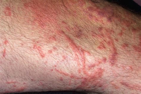 Contact Dermatitis And Patch Testing Clinical Tree