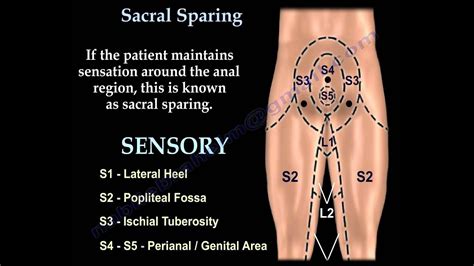 Sacral Sparing Everything You Need To Know Dr Nabil Ebraheim Youtube