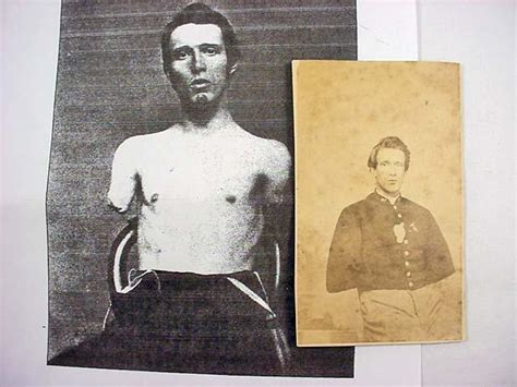 Civil War Era Cdv Photo Of Double Amputee Soldier