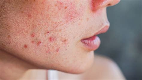 Mental Health Support For People With Acne