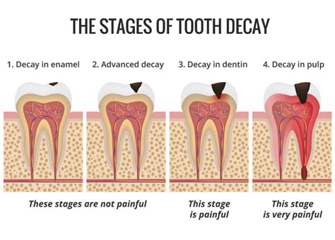 Dealing With Decay Dentist St Charles St Charles Dental