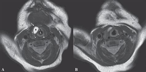 T2 Weighted Mri Images Of A Lateral Saccular Cyst Black Star Axial