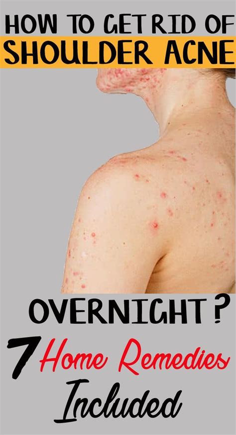 How To Get Rid Of Shoulder Acne Overnight Natural Ingredients Are