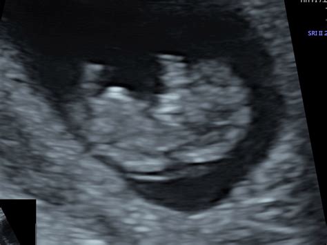 Specialist Scans Recurrent Miscarriage Firstscan At Window To The Womb