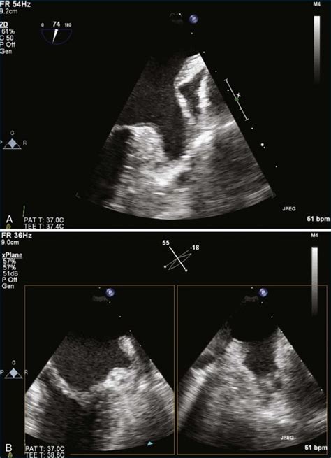 Mitral Stenosis Radiology Key