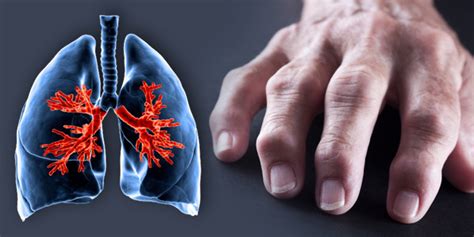 Effects Of Rheumatoid Arthritis On Lungs You Were Not Aware Of