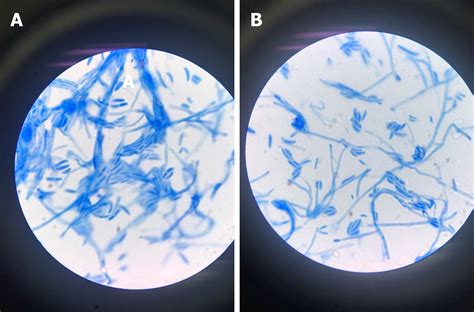 Disseminated Fusarium Bloodstream Infection In A Child With Acute