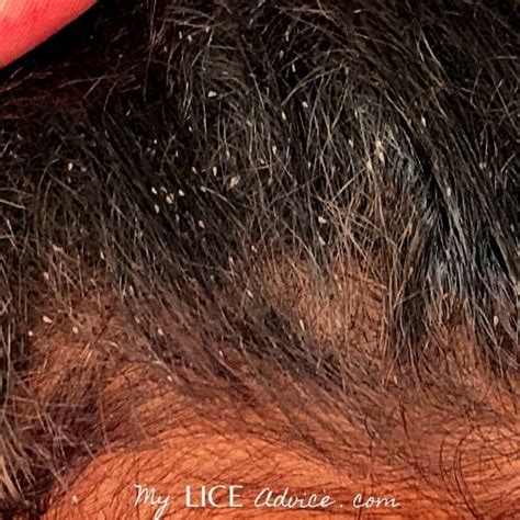 48 Best Pictures What Does Lice Look Like In Black Hair What Does It