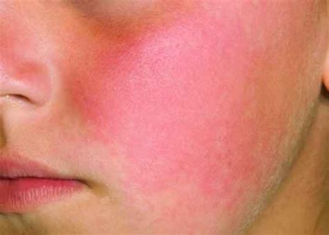 What Is Red Blotchy Skin Pictures Causes And How To Treat