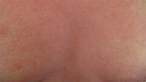 Heat Rash Pictures Remedies And More