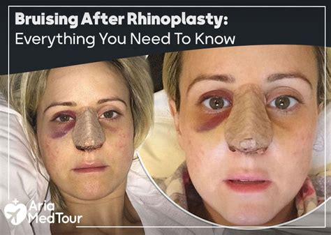 Unveiling The Mysteries How Long Does Bruising Last After Rhinoplasty