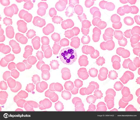 Human Blood Smear Leukocytosis Acute Infection Neutrophil Leukocyte