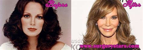 Jaclyn Smith Plastic Surgery Before And After Pic