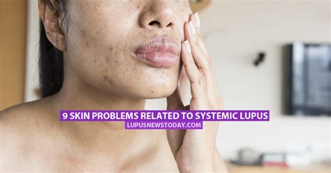 9 Skin Problems Related To Systemic Lupus Lupus News Today