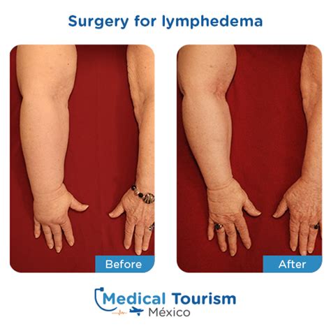 Vascular Surgeons For Lymphedema Medical Tourism Mexico