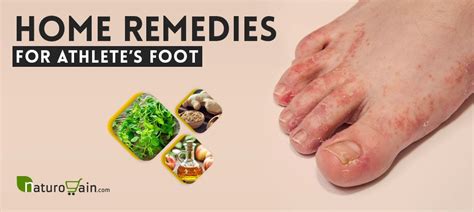 9 Best Home Remedies For Athletes Foot That Work Naturally
