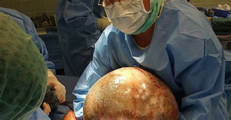 Alabama Woman Has 50 Pound Ovarian Cyst Removed After Mystery Weight