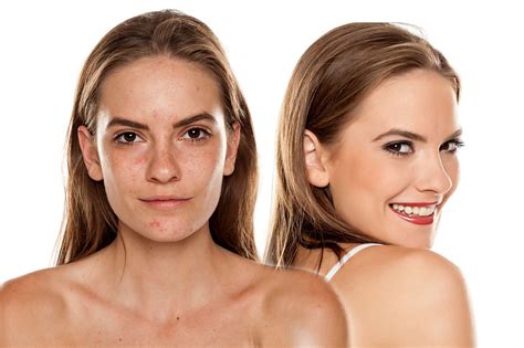 Got Acne Meet The Medical Grade Chemical Peel That Can Help Your Skin