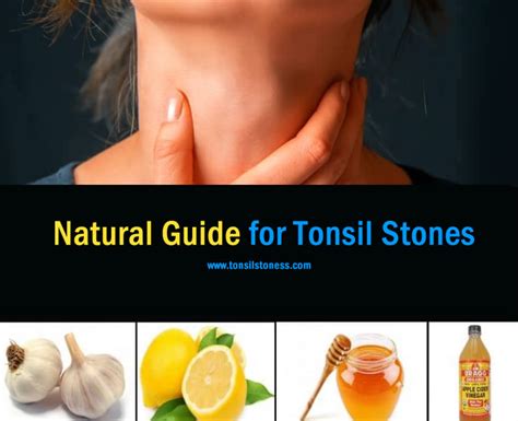 7 Natural Home Remedies To Cure Tonsil Stones