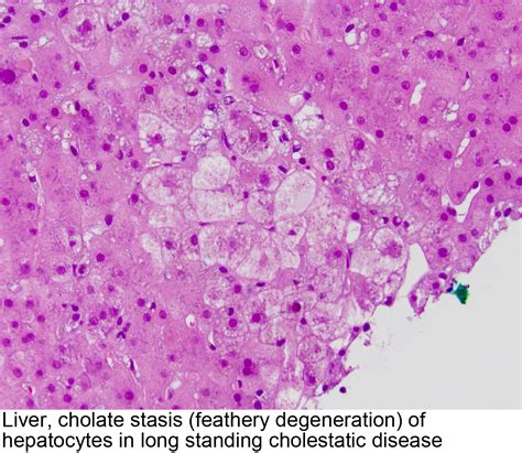 Pathology Outlines Cholestasis
