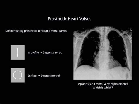 Prosthetic Heart Valves Radiologia
