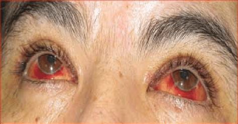Bilaterally Subconjunctival Hemorrhage In A Patient With Pandemic H1n1