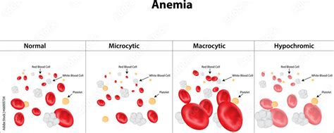 Microcytic Macrocytic And Hypochromic Anemia Stock Illustration