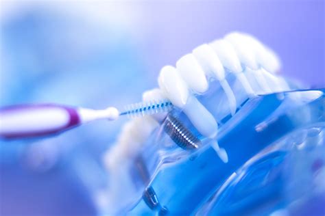 Complete Guide To Dental Implant Aftercare Elegantdentcare Blog