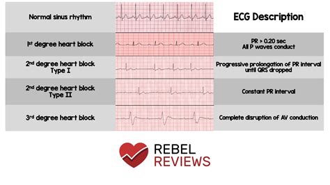 Av Heart Blocks Rebel Em Emergency Medicine Blog