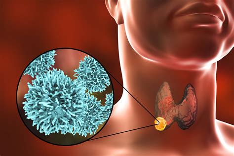 Papillary Thyroid Cancer Symptoms Causes Diagnosis And Treatment