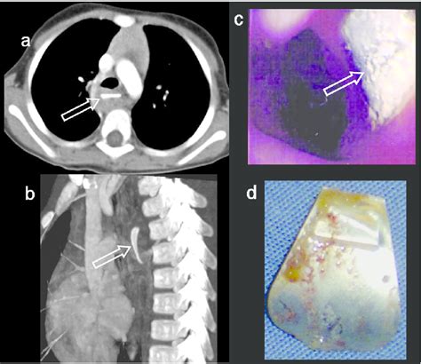 A Axial Contrast Enhanced Computed Tomography Demonstrate Linear Download Scientific Diagram