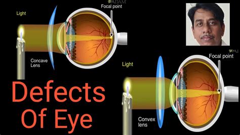 Human Eye And The Colorful World Defects And Corrections Class 10