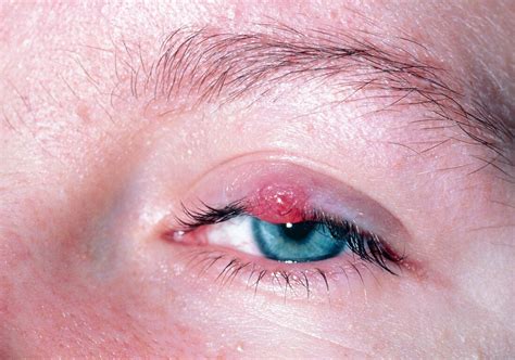 Chalazion In Upper Eyelid A Chalazion Also Known As A Meibomian Gland