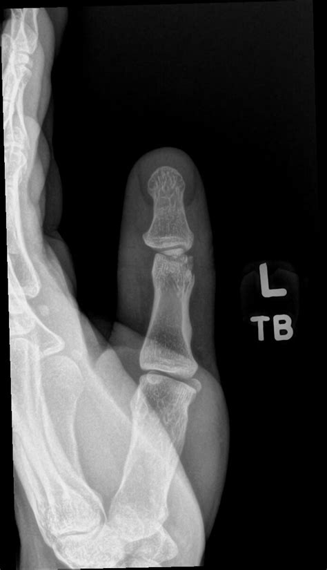 Orthodx Pain In Thumb Clinical Advisor