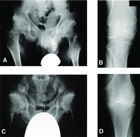A Anteroposterior Ap Radiographs Of The Hips Of A Representative