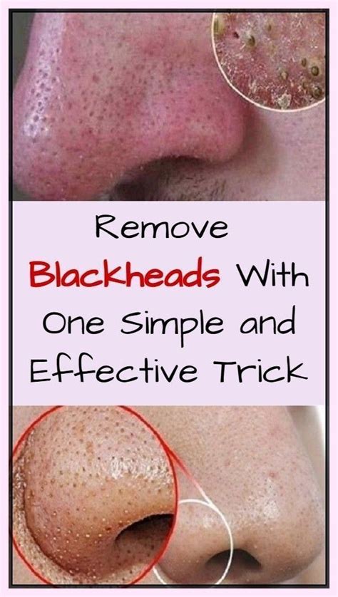 how to use hydrogen peroxide to remove blackheads artofit
