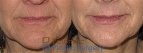 dermal fillers used to soften and enhance the lips of an older woman