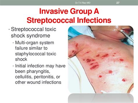 Streptococcus Infections And Complications