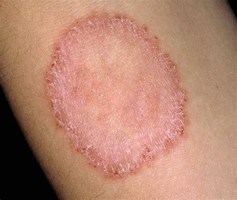 What Does Ringworm Look Like
