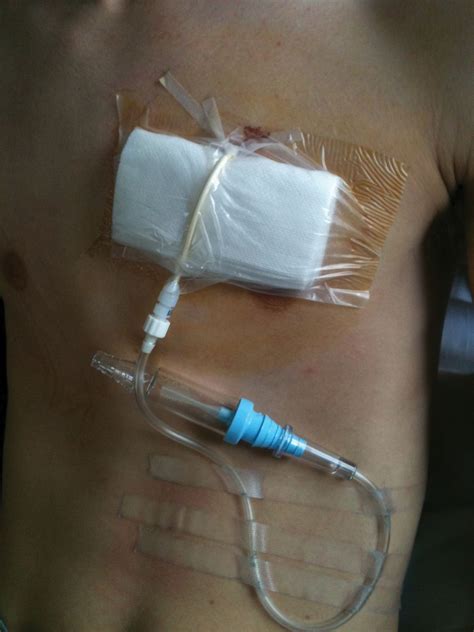 Chest tube insertion for pneumothorax or hematothorax.this video will show you how to insert a chest tube for a pneumothoraxthis patient has multiple rib fra. Outpatient management of primary spontaneous pneumothorax: a prospective study | European ...
