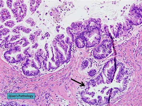 Qiaos Pathology Mucinous Cystadenocarcinoma Of Ovary A Photo On