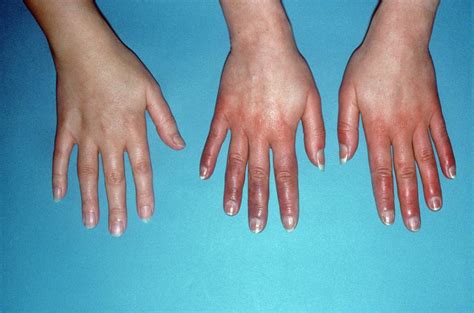 Acrocyanosis Of The Hands Photograph By St Bartholomew Hospitalscience